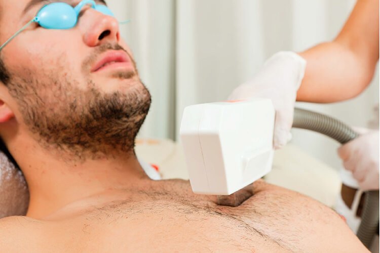 depilación láser en el pecho de hombre